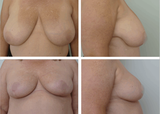 Breast Lift Portland Before and After Dr. Tina Jenq